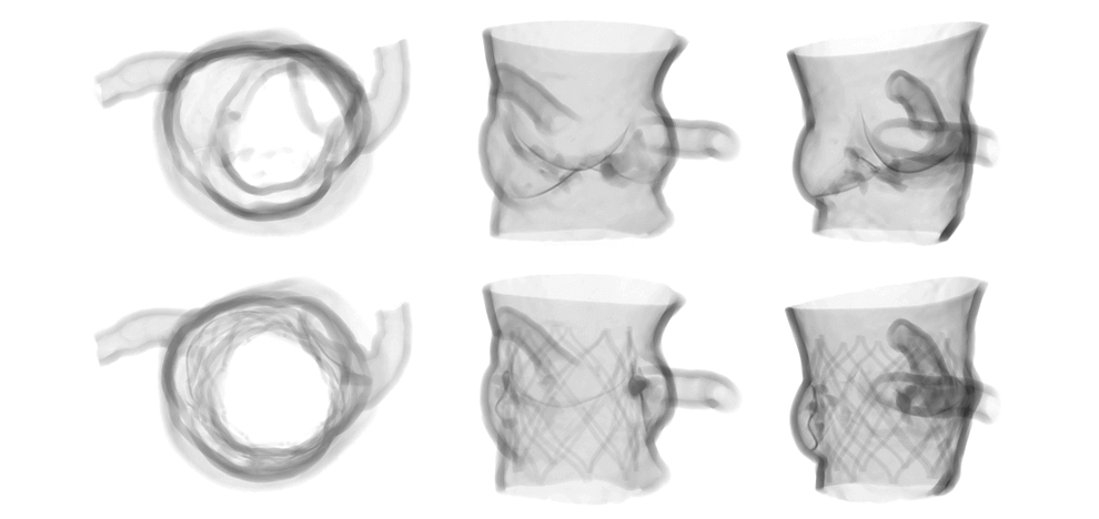 pre-procedural-fit-testing-transcatheter-aortic-valve-replacement-tavr-valves-using-parametric-modeling-3d-printing-11